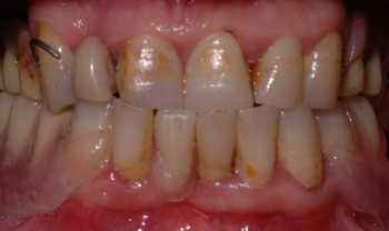 Protesi in poliammide in cavo orale